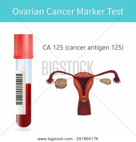 Blood Ovarian Cancer Marker Test. Ca 125. Uterus, Ovary With A Tumor. Vector Medical Illustration. W