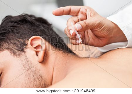 Doctor Performing Acupuncture On A Young Male Patient