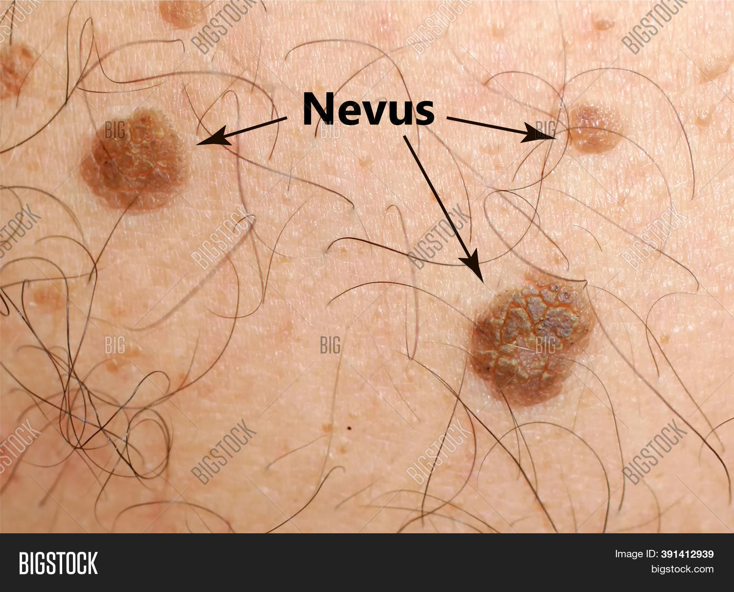 Brown Spot On Skin. Image & Photo (Free Trial) Bigstock