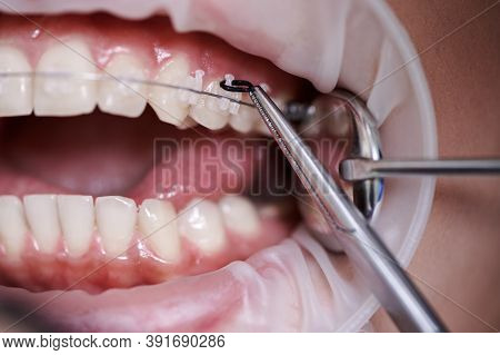 Close Up View On Dentist Taking Off Black Rubber Bands From Ceramic Braces With A Help Of Dental Hoo
