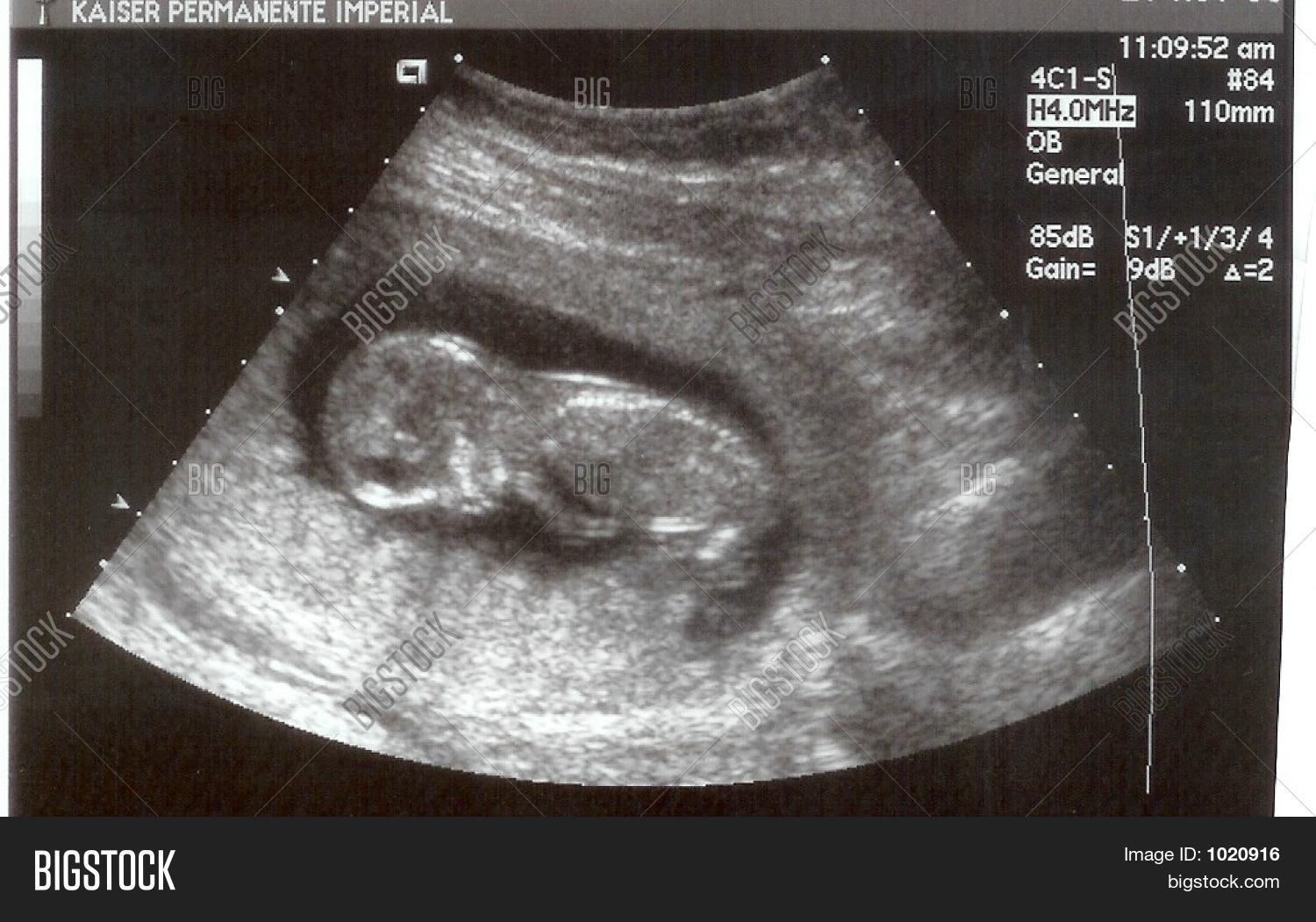 15 Week Fetus 3d Ultrasound Buttonlery
