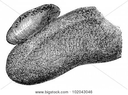 Angioma of the Human Tongue, vintage engraved illustration. Usual Medicine Dictionary by Dr Labarthe - 1885