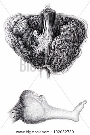 Anatomy of encephaloid tumor that requires amputation at the thigh, vintage engraved illustration. 