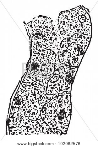 Cloudy swelling of the epithelial lining of the kidney tubule, vintage engraved illustration. 