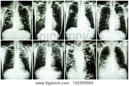 Pulmonary Tuberculosis Collection