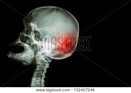 X-ray Skull Open Mouth ( Side View ) And Stroke ( Cerebrovascular Accident ( Cva ) )