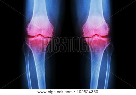 Osteoarthritis Knee ( Oa Knee ). Film X-ray Both Knee ( Front View ) Show Narrow Joint Space ( Joint