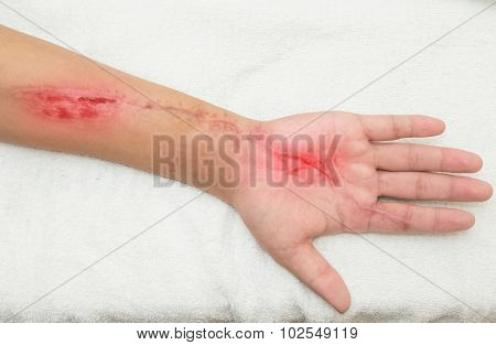 Inflammation  Wound In The Forearm