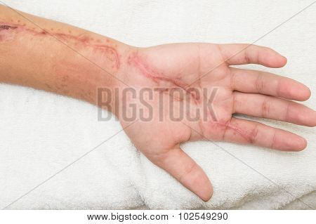 Inflammation  Wound In The Forearm