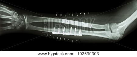 Fracture Both Bone Of Forearm ( Ulnar And Radius )