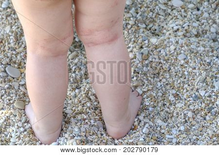 skin irritation newborn atopic dermatitis legs scratches