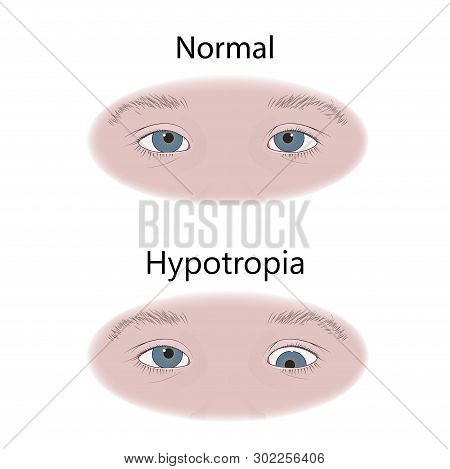 Strabismus In Infants, Child, Kid. Hypotropia, Downward Eyes. Comparison With Normal. Vector Flat Me