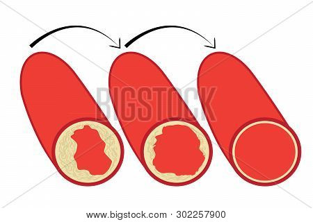 Reduce Levels Of Cholesterol Plaque In Vessels Vector Illustration On A White Background