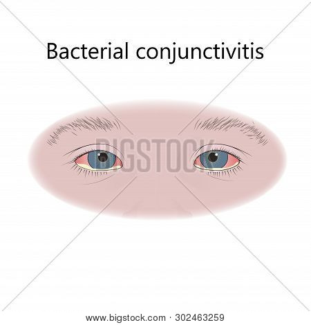 Bacterial Conjunctivitis. Infection. Vector Flat Medical Illustration.