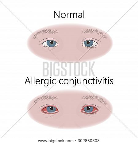 Allergic Conjunctivitis. Allergy. Comparison With Normal. Vector Flat Medical Illustration.