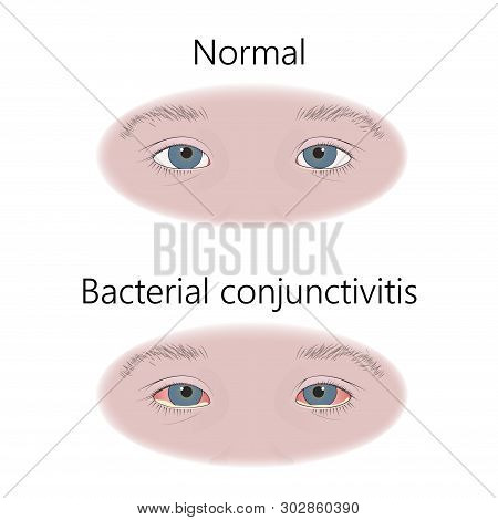 Bacterial Conjunctivitis. Infection. Comparison With Normal. Vector Flat Medical Illustration.