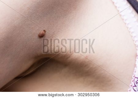 Unrecognizable Person Having Dark Fibroma, Dermatology Problem On Skin. Close Up Of Papilloma Dermat