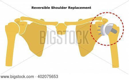 Reversible Shoulder Replacement. Shoulder Joint Replacement, Endoprosthetics. Osteoarthrosis Of The 