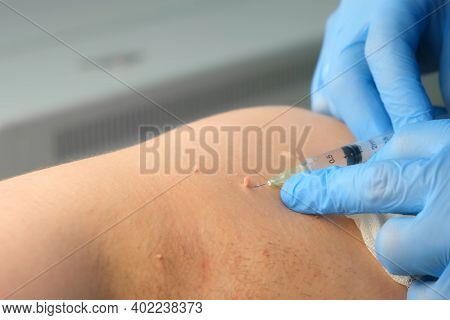 Surgeon In Gloves Gives Injection Of Local Anesthesia To Patient Before Laser Removing Moles Or Papi