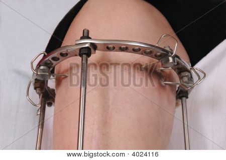 Orthopédie