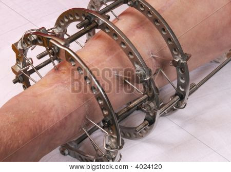 Orthopédie
