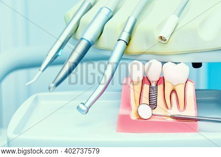 Implantology Concept. Dental Implants With Mirror In Dental Clinic.