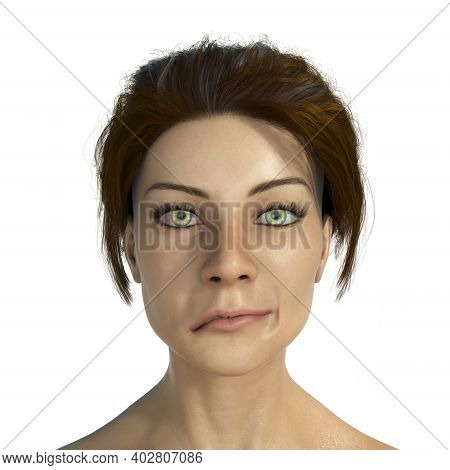 Facial Nerve Paralysis, Bells Palsy, 3d Illustration Showing Female With One-sided Facial Nerve Para