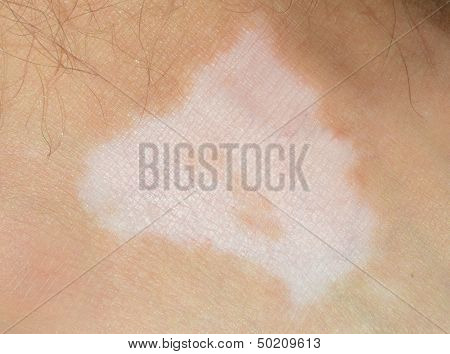 Vitiligo