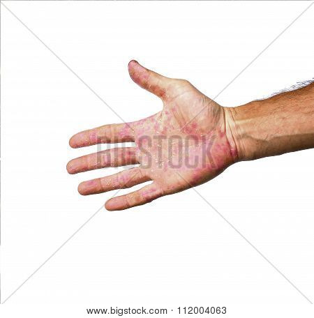 Palm Patient Erythema In Red In Ulcers From Inflammation Isolated