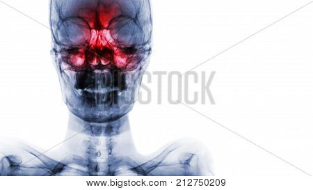 Sinusitis At Frontal , Ethmoid , Maxillary Sinus . Film X-ray Of Skull And Blank Area At Right Side