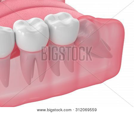 3d Render Of Jaw With Wisdom Mesial Impaction Over White Background. Concept Of Different Types Of W