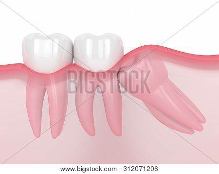 3D Render Of Jaw With Wisdom Mesial Impaction