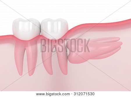 3d Render Of Jaw With Wisdom Horizontal Impaction Over White Background. Concept Of Different Types 