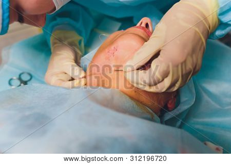 Aged Woman Doing Mesothreads And Thread Lifting, Cosmetology. Cosmetic Procedure To Eliminate Signs 
