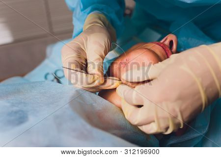 Aged Woman Doing Mesothreads And Thread Lifting, Cosmetology. Cosmetic Procedure To Eliminate Signs 