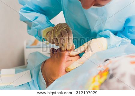 Aged Woman Doing Mesothreads And Thread Lifting, Cosmetology. Cosmetic Procedure To Eliminate Signs 