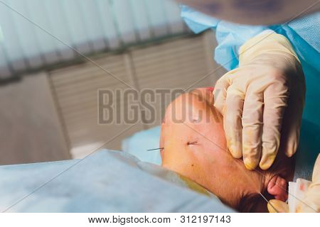 Aged Woman Doing Mesothreads And Thread Lifting, Cosmetology. Cosmetic Procedure To Eliminate Signs 