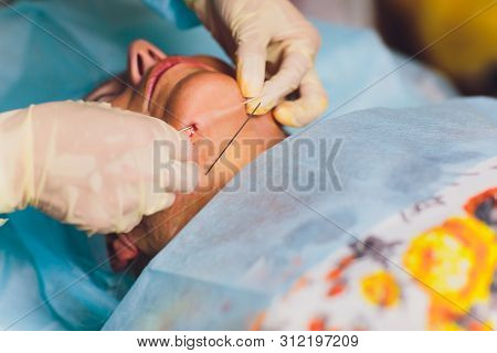 Aged Woman Doing Mesothreads And Thread Lifting, Cosmetology. Cosmetic Procedure To Eliminate Signs 