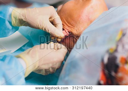 Aged Woman Doing Mesothreads And Thread Lifting, Cosmetology. Cosmetic Procedure To Eliminate Signs 