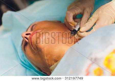 Aged Woman Doing Mesothreads And Thread Lifting, Cosmetology. Cosmetic Procedure To Eliminate Signs 