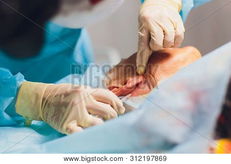 Aged Woman Doing Mesothreads And Thread Lifting, Cosmetology. Cosmetic Procedure To Eliminate Signs 