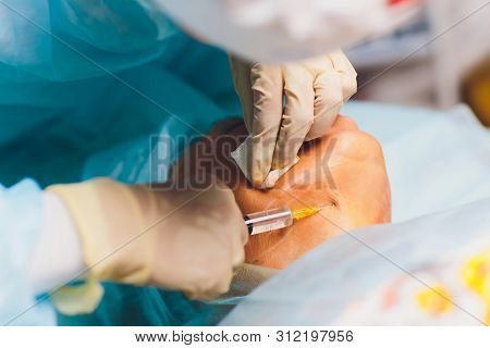 Aged Woman Doing Mesothreads And Thread Lifting, Cosmetology. Cosmetic Procedure To Eliminate Signs 
