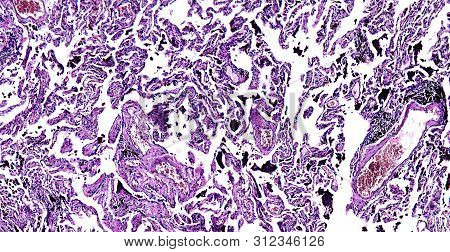 Histology Of Human Tissue, Show Chronic Congestion Of Lung As Seen Under The Microscope, 10x Zoom