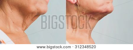 Aged Woman Doing Mesothreads And Thread Lifting, Cosmetology. Cosmetic Procedure To Eliminate Signs 