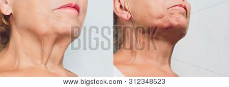 Aged Woman Doing Mesothreads And Thread Lifting, Cosmetology. Cosmetic Procedure To Eliminate Signs 