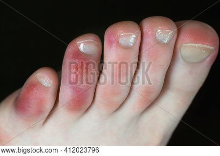 Covid Toes. Coronavirus Symptoms - Swelling And Discoloration, Purplish Color, Pain And Rough Skin.