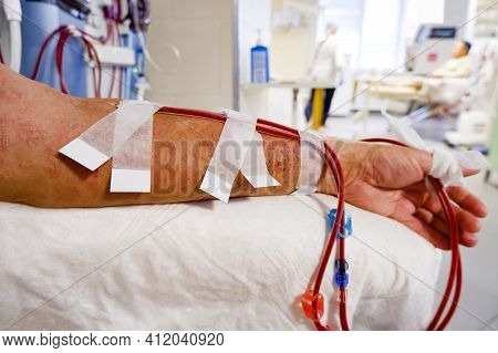 The Hand Of A Patient With A Skin Lesion Is Connected To A Hemodialysis Machine.