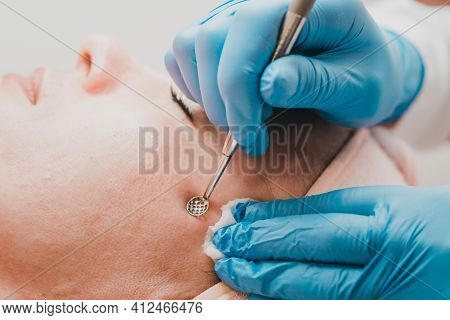 Mechanical Cleansing Of The Face With A Spoon Uno, Removing Grease And Blackheads.