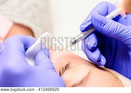 Milium On The Face, Removal Of Milia With A Syringe In Cosmetology.