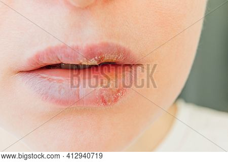 Close Up Of Girl Lips Affected By Herpes. Treatment Of Herpes Infection And Virus. Part Of Young Wom